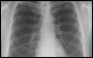 В Свердловской области будут делать КТ легких всем пациентам с COVID-19